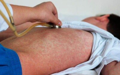 El brote de sarampión en Oaxaca está controlado, con 5 casos confirmados hasta el momento: SSO
