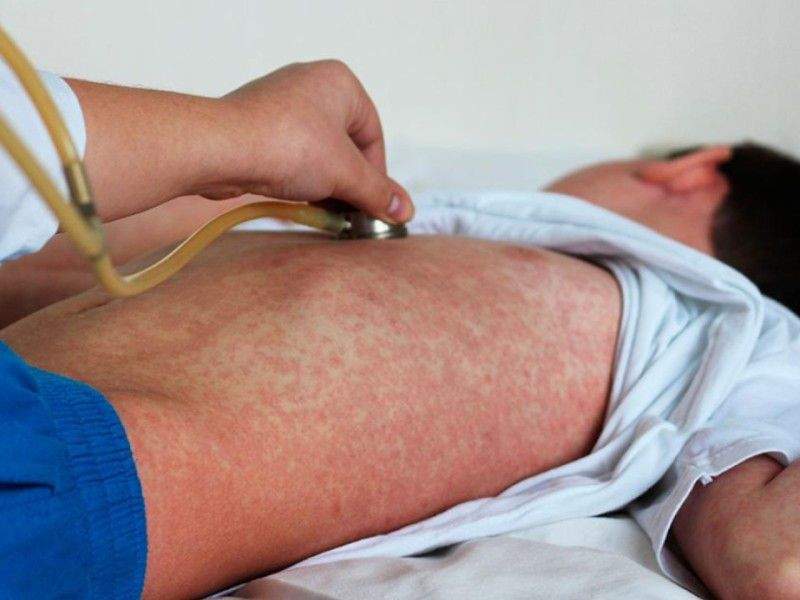 El brote de sarampión en Oaxaca está controlado, con 5 casos confirmados hasta el momento: SSO