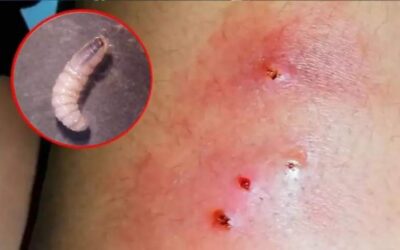 Se registran dos casos humanos de Miasis por Gusano Barrenador del Ganado en Oaxaca